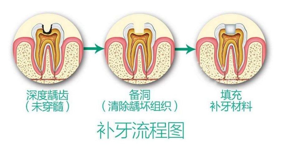 佳美口腔補(bǔ)牙流程圖
