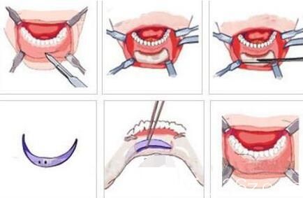 假體墊下巴手術(shù)過程示意圖