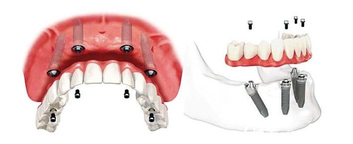 特色技術(shù)one-day-apple種植牙技術(shù) 特色技術(shù)one-day-apple種植牙技術(shù)