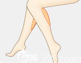 小腿吸脂后可以走路嗎？韓國365mc吸脂醫(yī)院李善鎬來解答