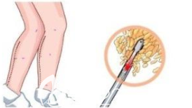 小腿吸脂手術(shù)示意圖