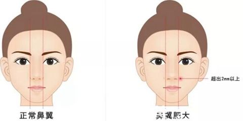 漯河締美儷鼻頭鼻翼縮小