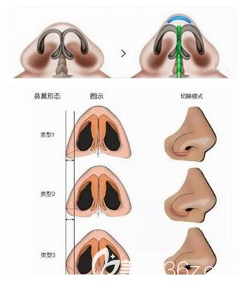 漯河締美儷鼻頭縮小原理