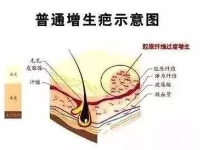 漯河締美儷鼻翼縮小疤痕增生問(wèn)題