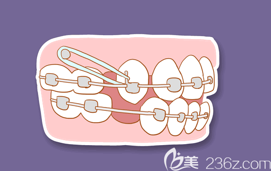 陳聰慧說有些牙合畸形是必須要拔牙的 陳聰慧說有些牙合畸形是必須要拔牙的