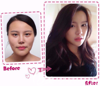 韓國女神整形顴骨整形真人案例