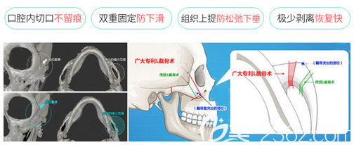 廣州廣大整形醫(yī)院柳超做顴骨顴弓縮小手術(shù)優(yōu)勢(shì) 廣州廣大整形醫(yī)院柳超做顴骨顴弓縮小手術(shù)優(yōu)勢(shì)