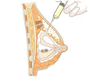 自體脂肪豐胸的原理