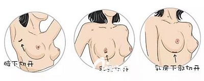 假體隆胸的切開(kāi)所在位置