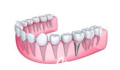 長(zhǎng)沙科爾雅口腔諶志遠(yuǎn)介紹微創(chuàng)種植牙的優(yōu)勢(shì)