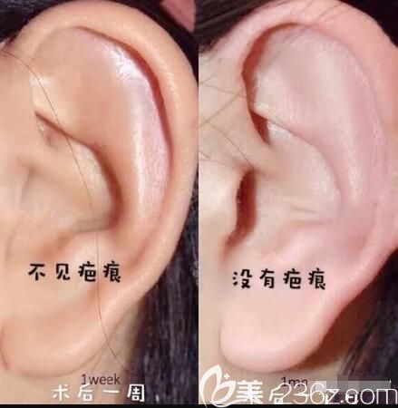 取自體耳軟骨基本上不會(huì)留疤 取自體耳軟骨基本上不會(huì)留疤