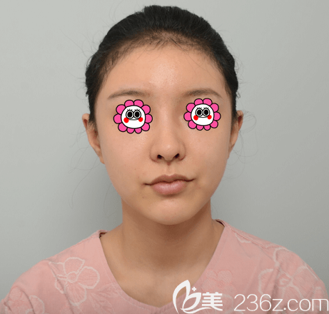 在韓國Profile普羅菲耳做貼發(fā)耳矯正前樣子 在韓國Profile普羅菲耳做貼發(fā)耳矯正前樣子