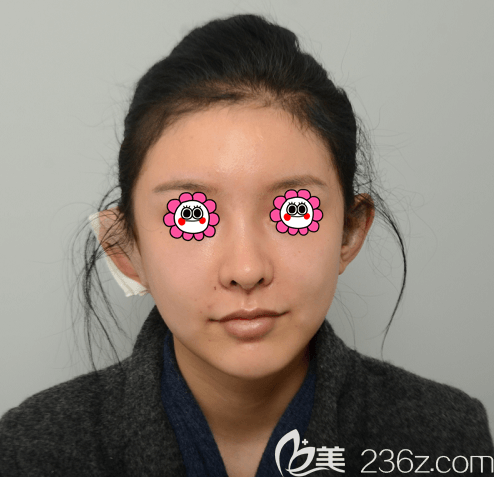 之前在韓國(guó)Profile普羅菲耳做面部輪廓手術(shù)還行這次做了貼發(fā)耳矯正術(shù)