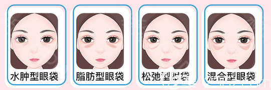 各種不同類型的眼袋