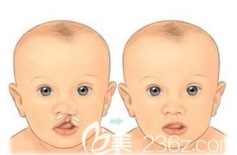 韓國唇裂修復(fù)哪家醫(yī)院好？