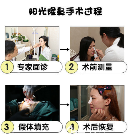 整形醫(yī)院羅志敏隆鼻案例過程圖