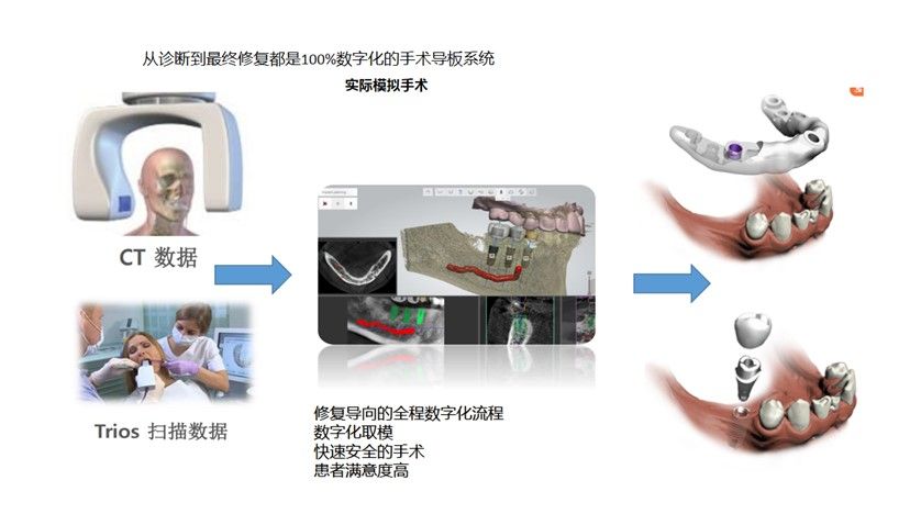 和仁堂的DIOnavi種牙特色技術(shù)流程