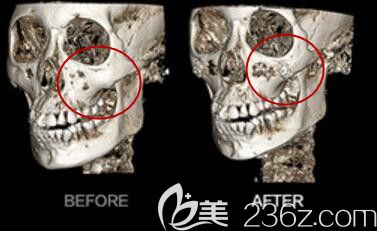 韓國美迪瑩整形醫(yī)院無縫隙3D顴骨縮小術(shù)前后CT效果對比圖