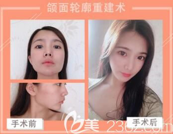 韓國創(chuàng)造美5D面部輪廓立體術(shù)真人前后對比效果