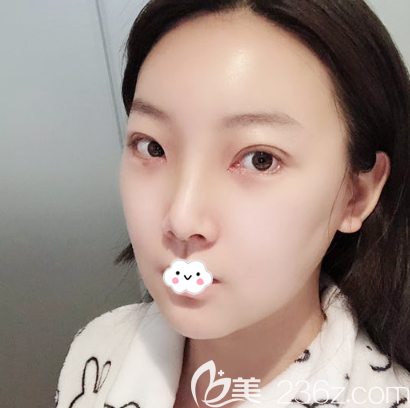 雙眼皮開(kāi)眼角術(shù)后10天效果圖