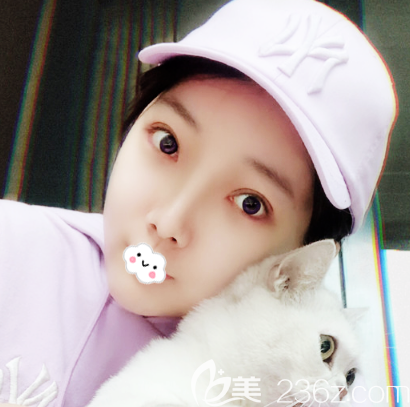 韓國(guó)id金一煥院長(zhǎng)雙眼皮案例術(shù)后一個(gè)月效果圖