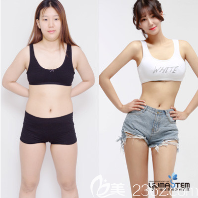 韓國(guó)維摩整形外科全身吸脂案例