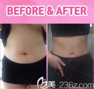 韓國ROVL勞波兒整形醫(yī)院吸脂瘦腰腹真人前后對比照