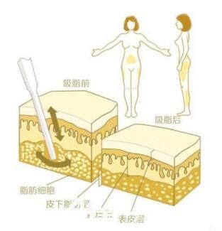 韓國ROVL勞波兒整形醫(yī)院做吸脂效果好不好？