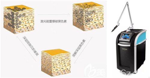 杜主任采用皮秒激光祛斑的治療原理圖 杜主任采用皮秒激光祛斑的治療原理圖