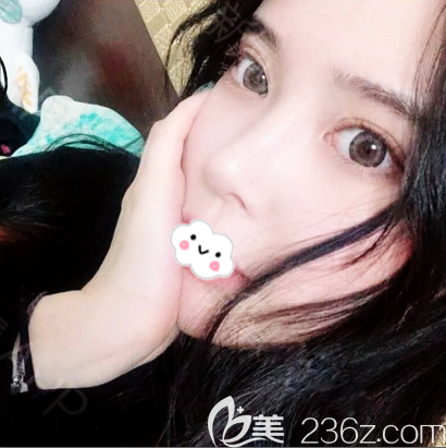 親自找廣州紫馨金孝憲做完鼻子修復后才敢說金孝憲鼻修復技術(shù)果然出神入化