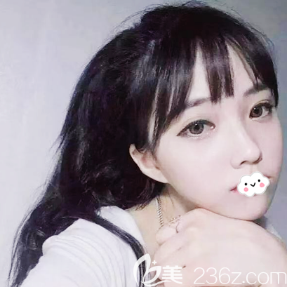 廣州紫馨金孝憲做的鼻修復(fù)案例效果圖 廣州紫馨金孝憲做的鼻修復(fù)案例效果圖