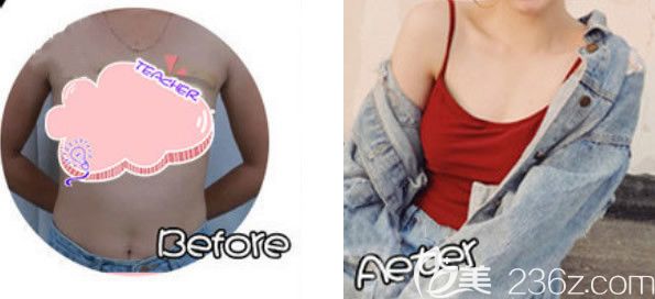 蘭州韓美副乳抽脂前后效果對(duì)比圖