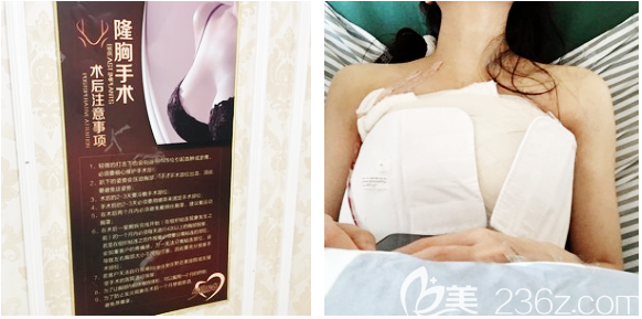 廣州壹加壹隆胸術(shù)后7天恢復照片 廣州壹加壹隆胸術(shù)后7天恢復照片