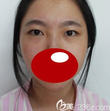 <i data-id='d68550cc-1240-4c94-b9dc-67d5c1c75313' style='display:none;'></i>西華張慧慧為我做雙眼皮術(shù)前照 <i data-id='d68550cc-1240-4c94-b9dc-67d5c1c75313' style='display:none;'></i>西華張慧慧為我做雙眼皮術(shù)前照