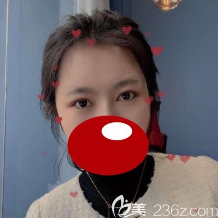 <i data-id='d68550cc-1240-4c94-b9dc-67d5c1c75313' style='display:none;'></i>西華張慧慧為我做雙眼皮術(shù)后1個月效果 <i data-id='d68550cc-1240-4c94-b9dc-67d5c1c75313' style='display:none;'></i>西華張慧慧為我做雙眼皮術(shù)后1個月效果