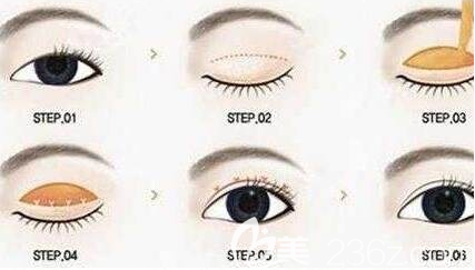 韓國GNG醫(yī)院芭比電眼