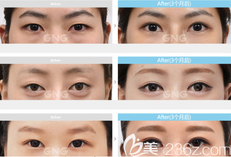 韓國GNG醫(yī)院眼部整形真人案例圖