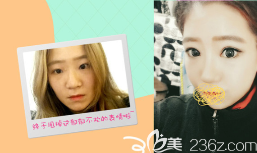 韓國GNG醫(yī)院眼部真人案例術前術后對比圖