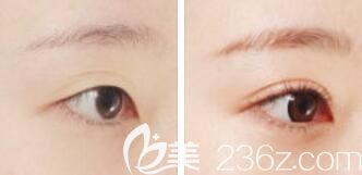 韓國夢想整形醫(yī)院雙螺旋埋線雙眼皮真人前后對比效果圖