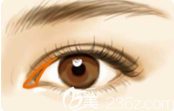 韓國開眼角怎么樣