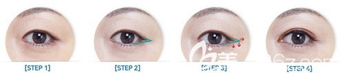 韓國寶士麗開眼角手術示意圖