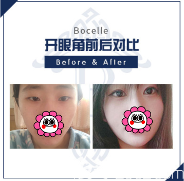 韓國寶士麗開眼角案例