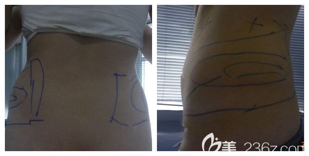 術(shù)前面診連云港華美腰腹部肥胖 術(shù)前面診連云港華美腰腹部肥胖