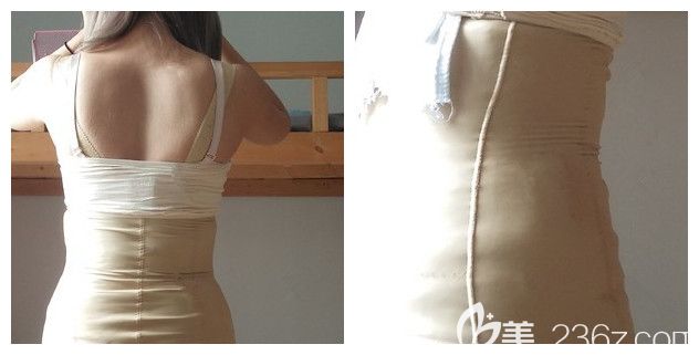 做完多維吸脂腰腹部穿戴塑身衣 做完多維吸脂腰腹部穿戴塑身衣