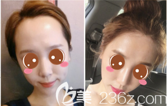 韓國額頭縮小哪家正規(guī)靠譜？韓國毛杰琳額頭縮小+發(fā)際線種植真人案例給你答案