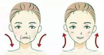 面部埋線提升前后效果對比