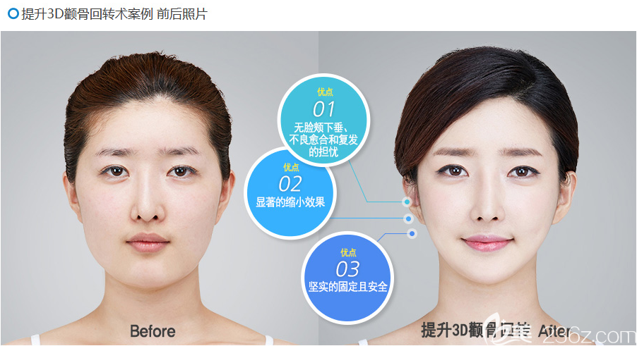 韓國(guó)博朗溫金兌奎顴骨案例