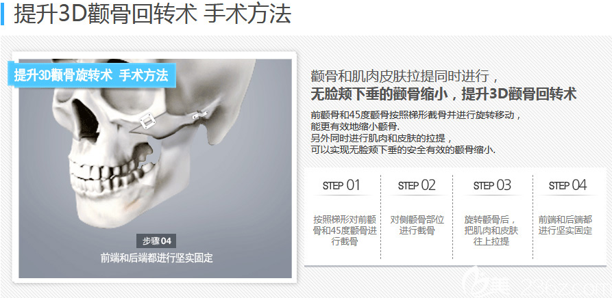 韓國(guó)博朗溫金兌奎顴骨手術(shù)方法示意圖