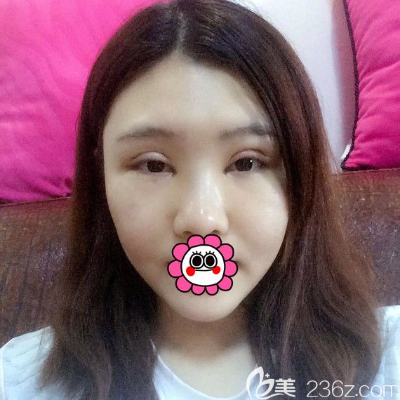 雙眼皮修復(fù)術(shù)后五天