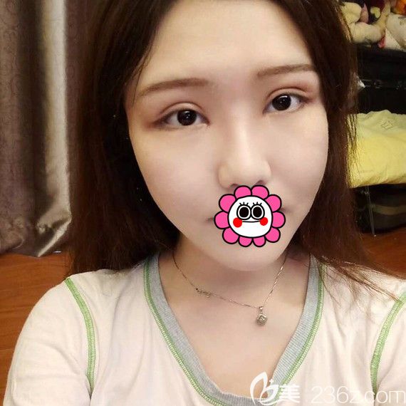 溫州藝星雙眼皮修復(fù)8天